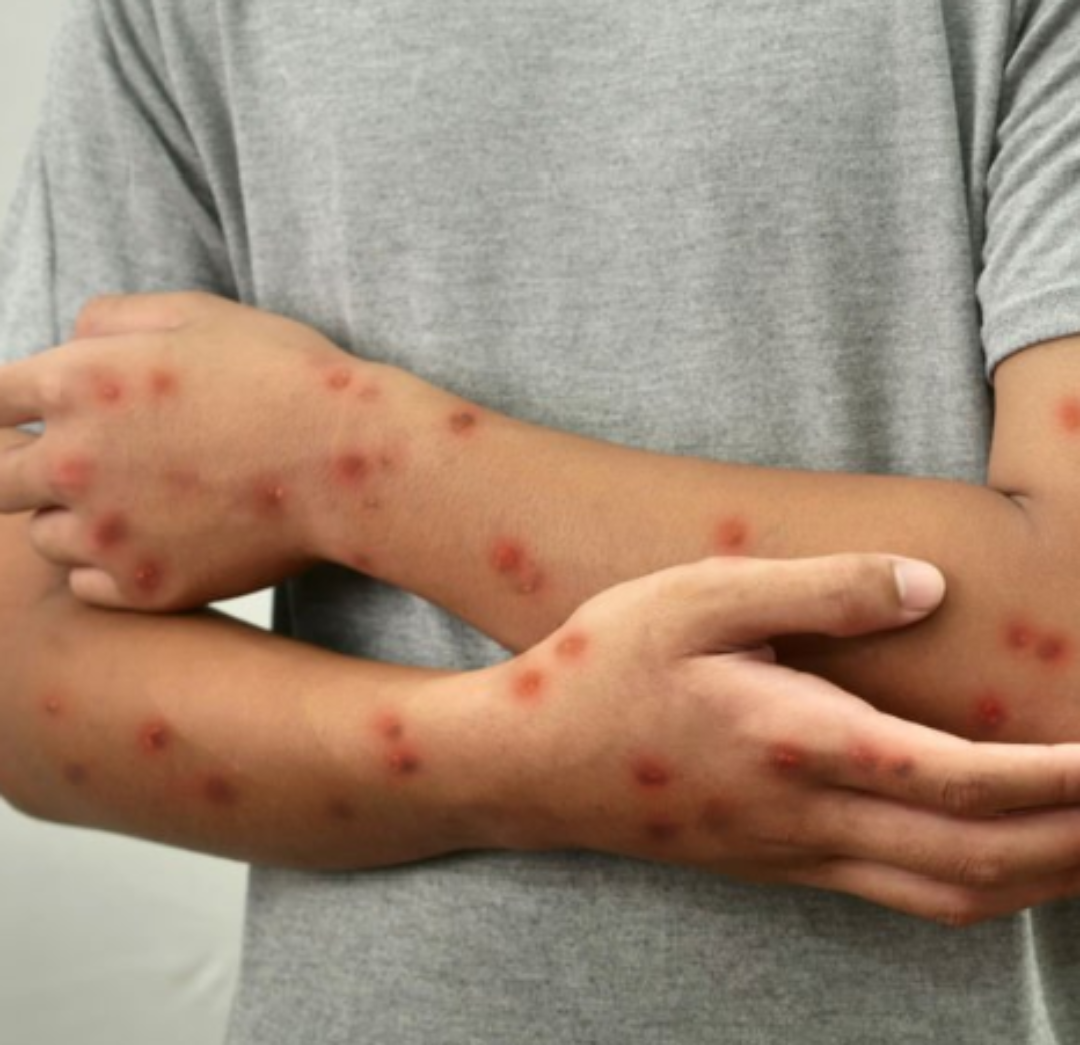 LA OMS DECLARA EMERGENCIA:  la viruela del mono regresa con una variante mas peligrosa.
